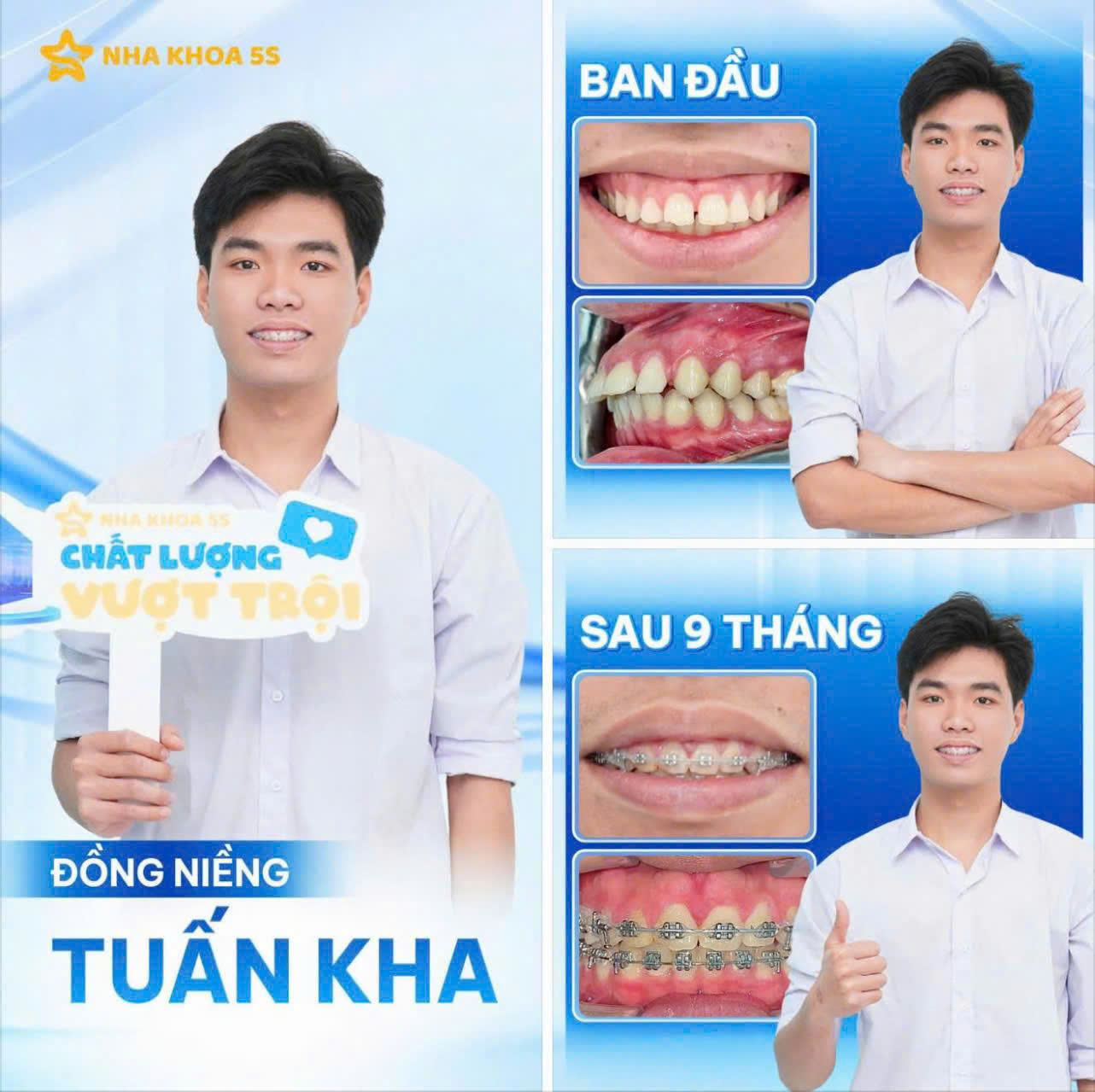 bảng giá niềng răng
