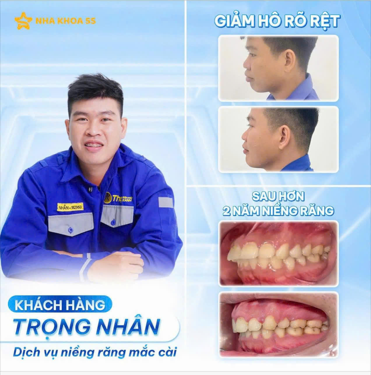 bảng giá niềng răng