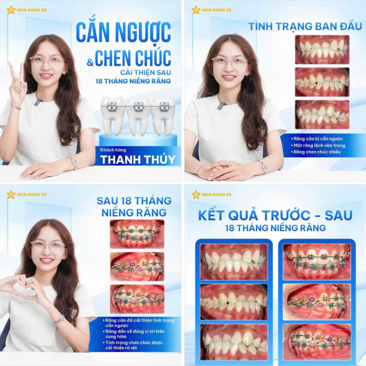 bảng giá niềng răng