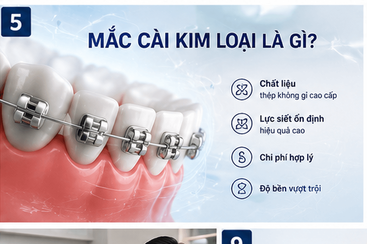 Bảng giá niềng răng mắc cài kim loại