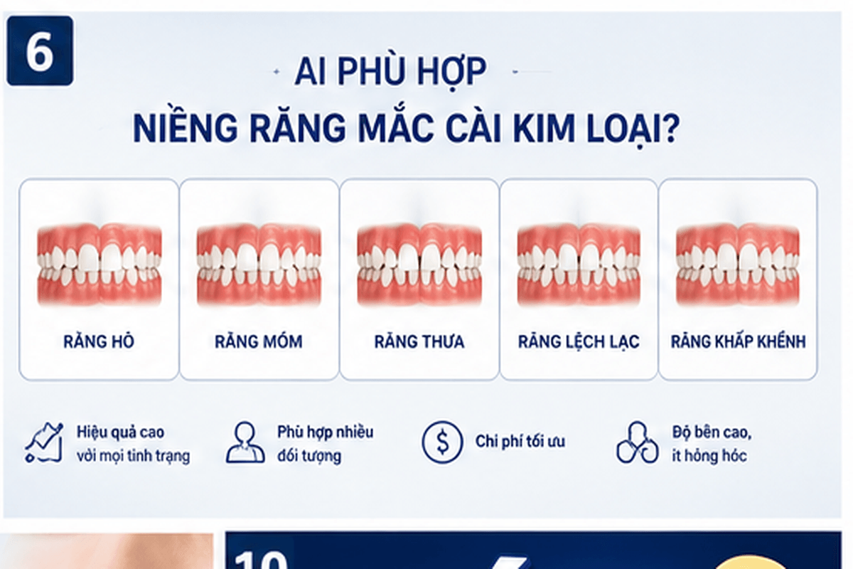 Bảng giá niềng răng mắc cài kim loại