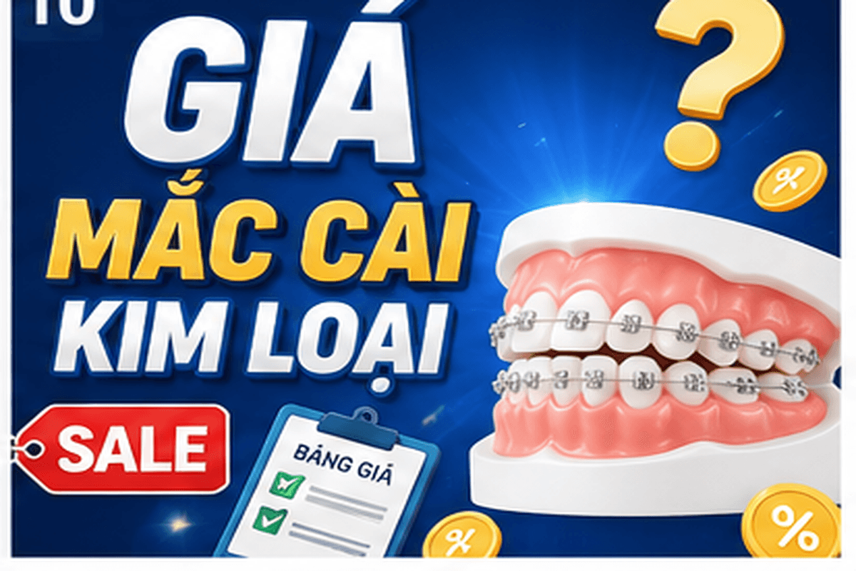 Bảng giá niềng răng mắc cài kim loại