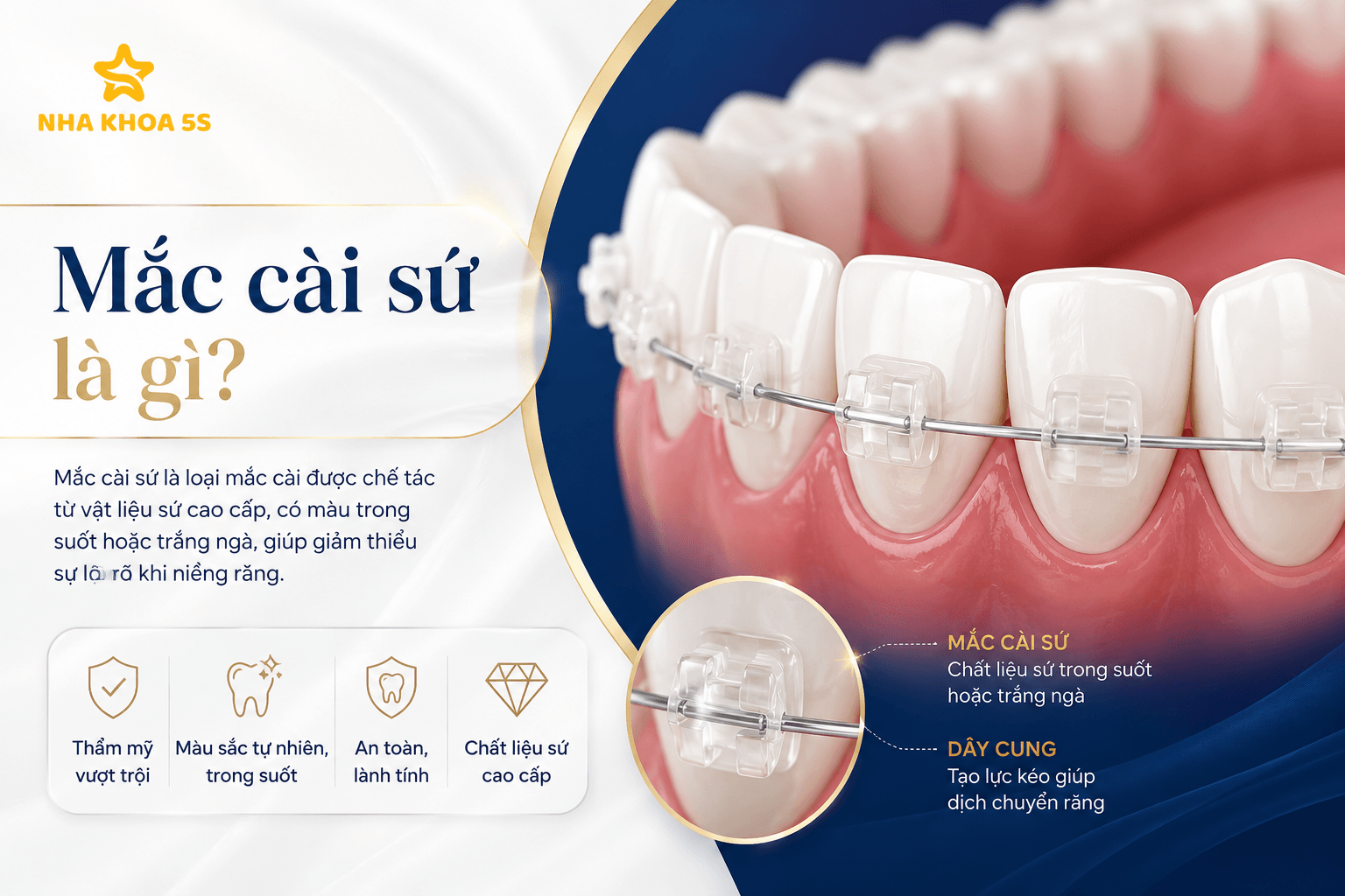 Bảng giá niềng răng mắc cài cho người phù hợp chỉnh nha