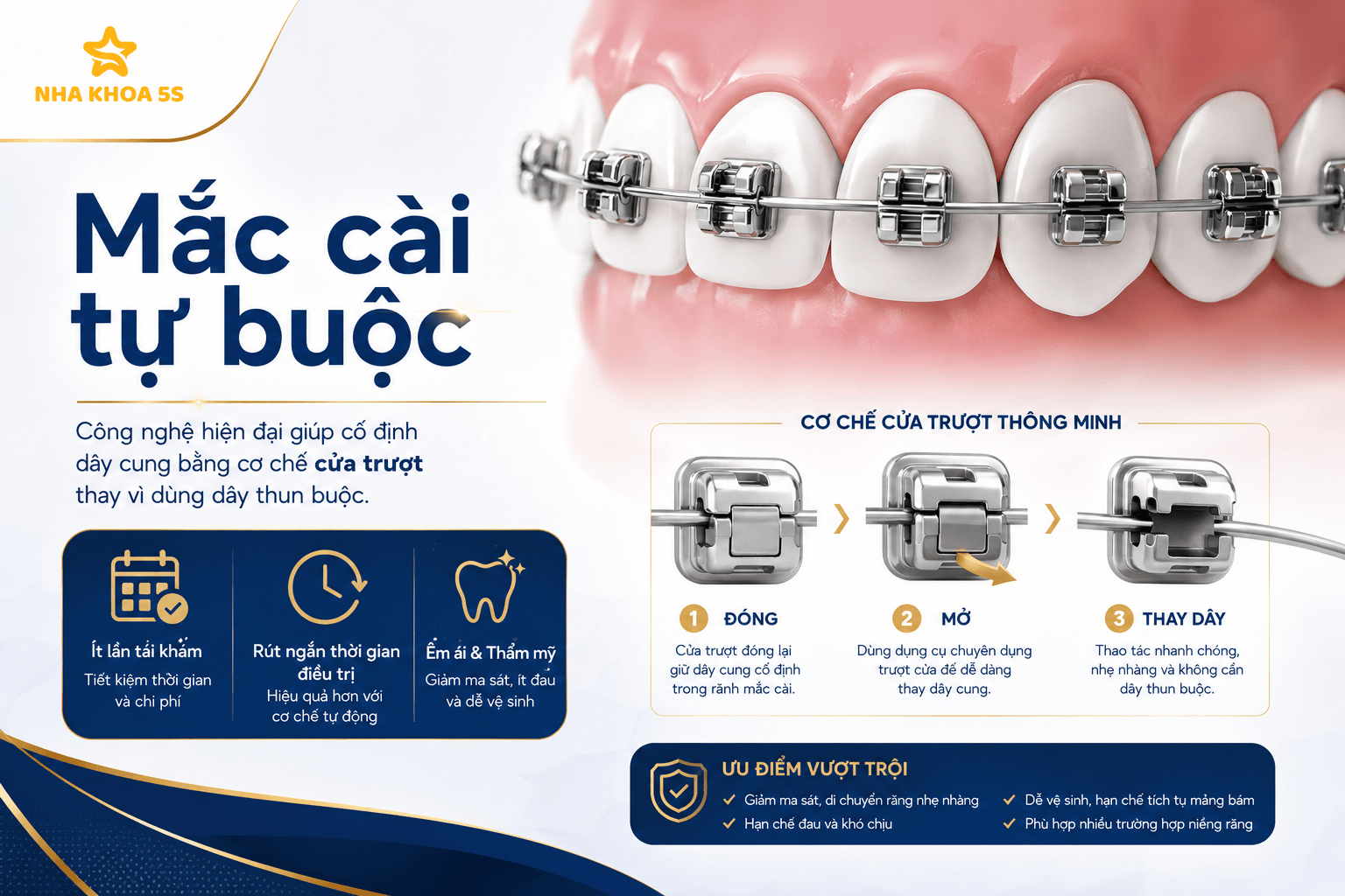 Bảng giá niềng răng mắc cài so sánh các loại mắc cài
