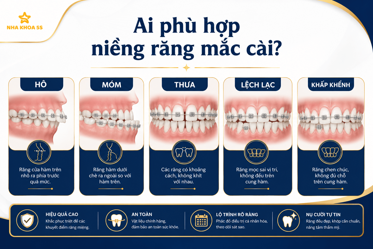 Bảng giá niềng răng mắc cài sứ thẩm mỹ cao cấp