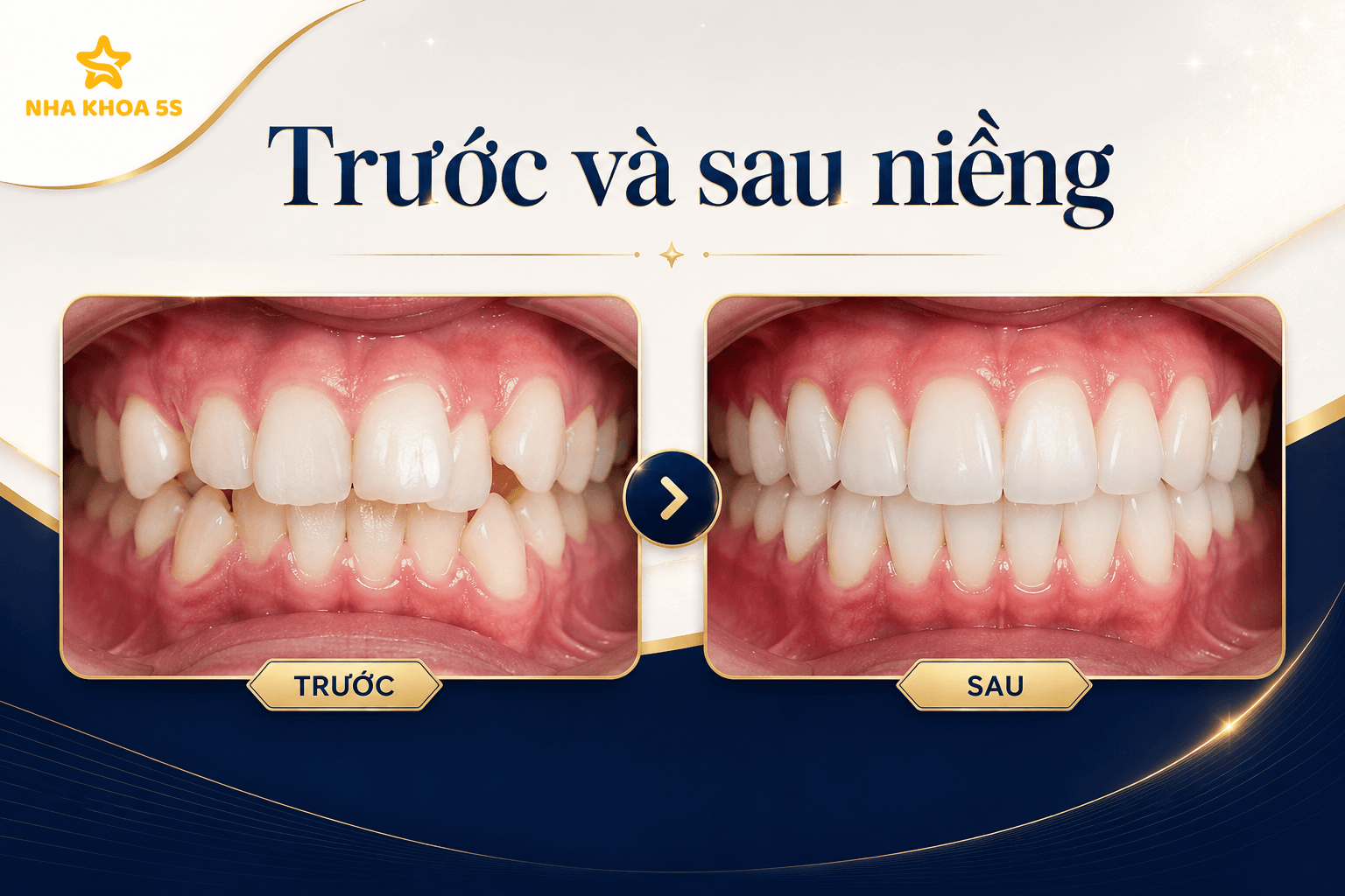 Bảng giá niềng răng mắc cài sứ cho người cần thẩm mỹ